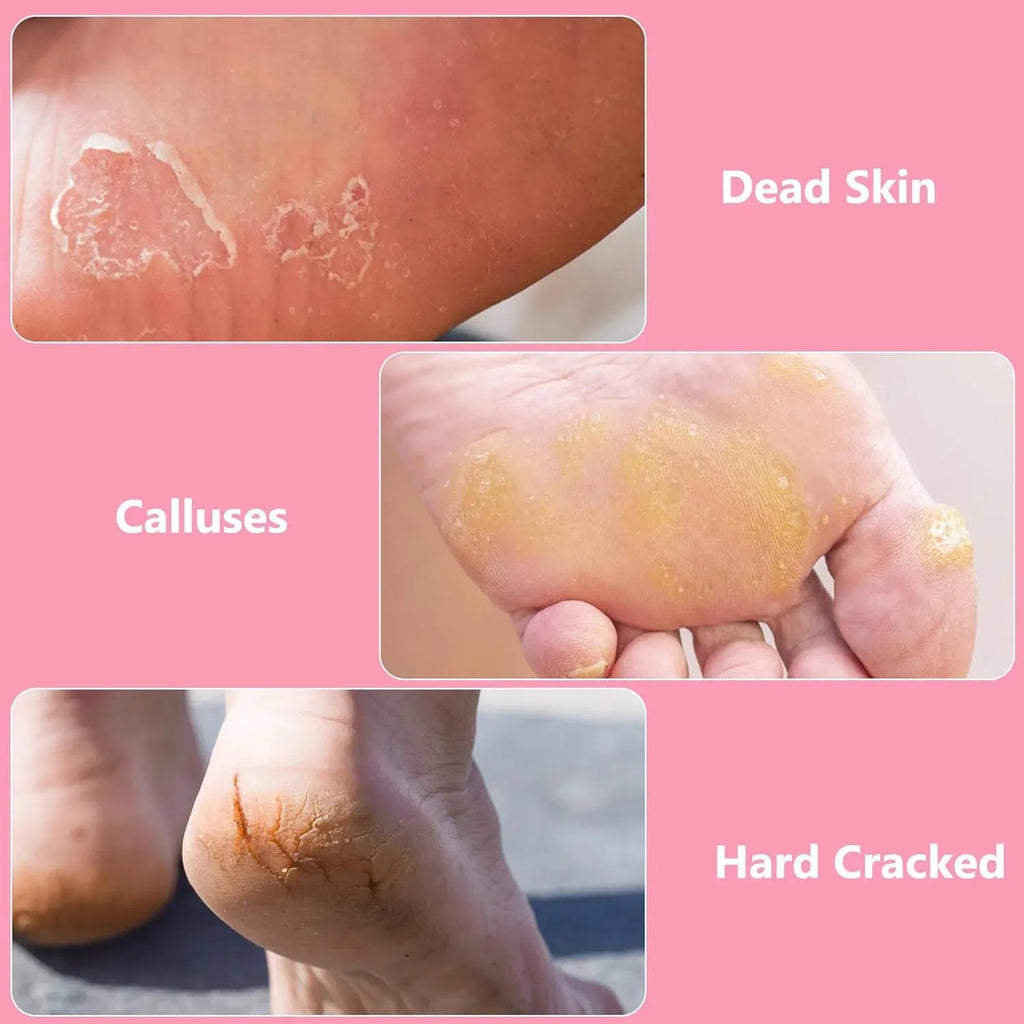 Foot File Callus Remover, Stainless Steel Pedicure Scrubber for Hard Cracked Dead Skin, Wet and Dry Foot Care, Pink