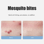 Bug Bite Itch Relief Tool USB Rechargeable Mosquito Bite Sucker Chemical Free for Bug Bites Bee Wasp Stings
